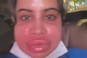 Urfi Javed boldly shares lip fillers dissolving journey on Instagram